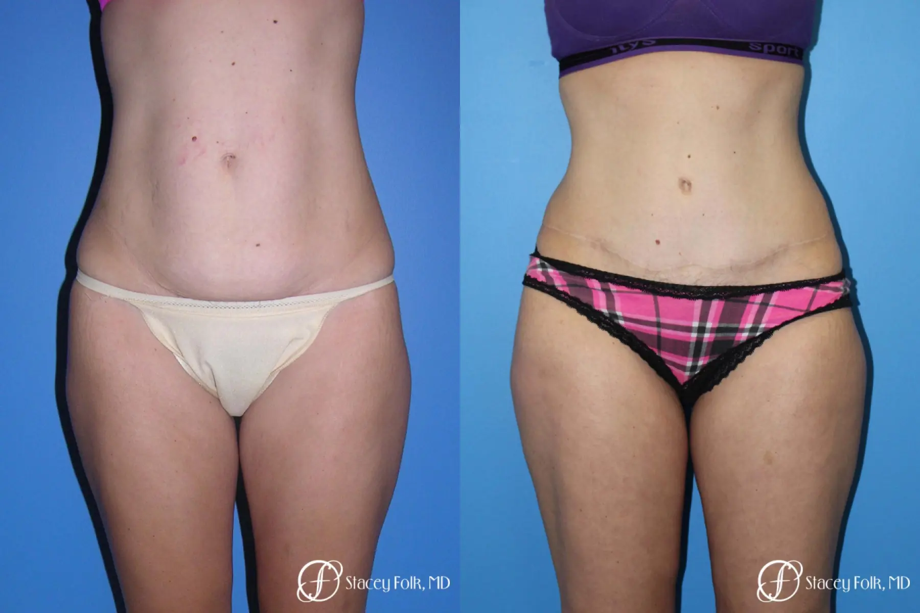 Denver Tummy Tuck (Abdominoplasty) 4782 - Before and After 1