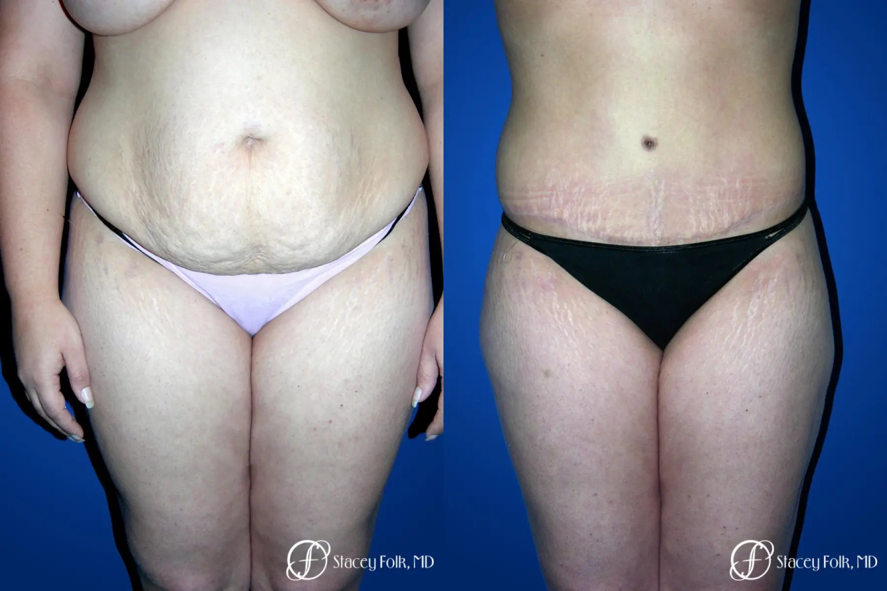 Denver Tummy Tuck 23 - Before and After 1