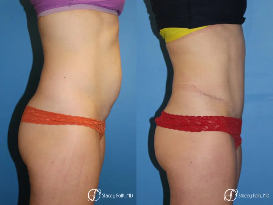 Denver Tummy Tuck - Abdominoplasty 8266 - Before and After 2
