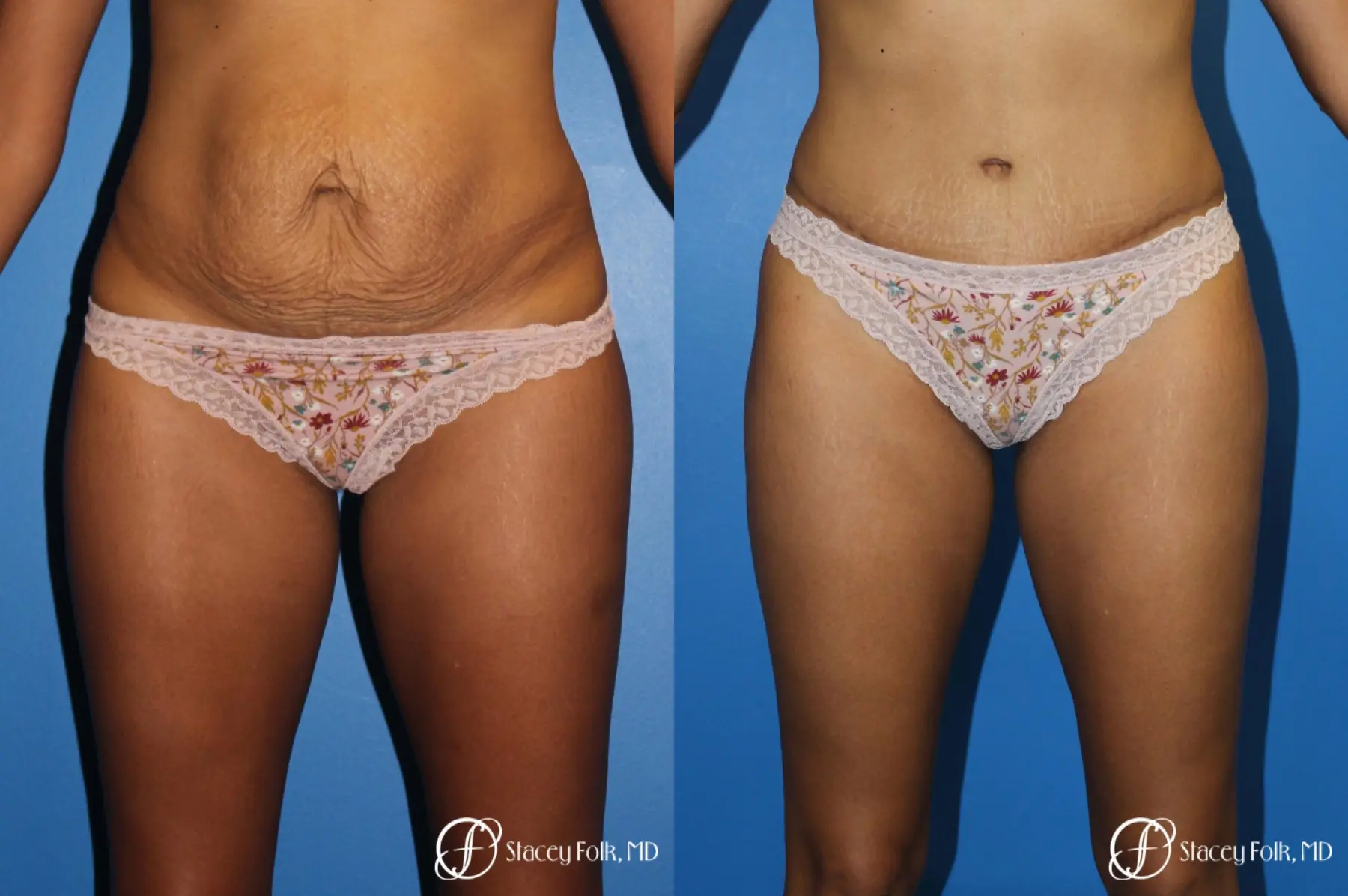 Tummy Tuck (Abdominoplasty) - Before and After