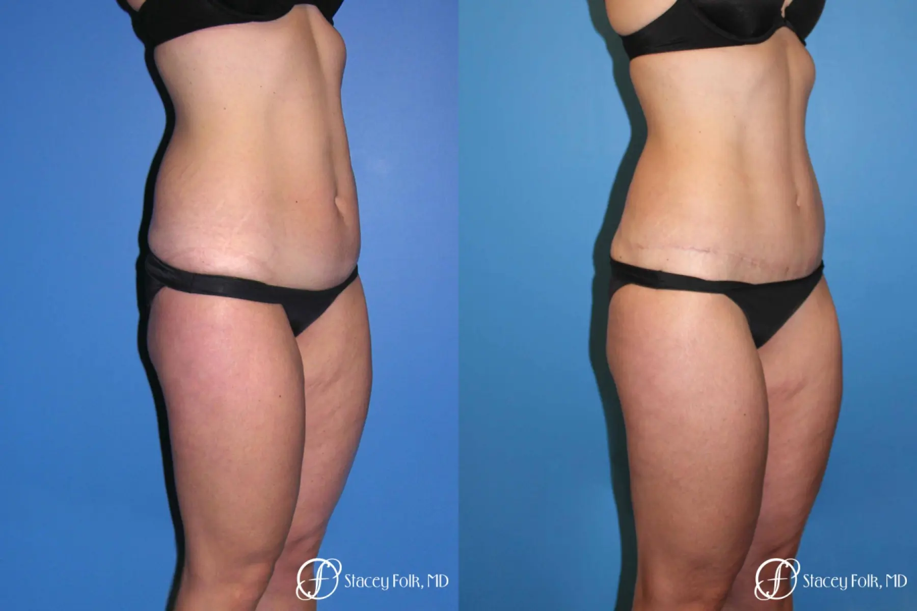 Denver Tummy Tuck Abdominoplasty and liposuction 4880 - Before and After 2