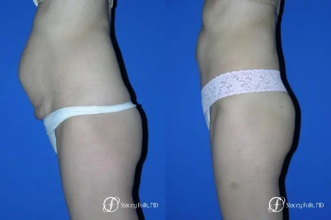 Denver Tummy Tuck 20 - Before and After 2