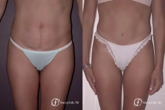 Denver Tummy Tuck 22 - Before and After 1