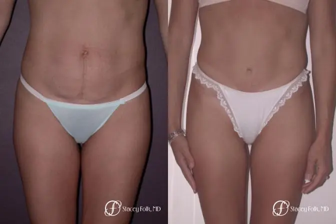 Denver Tummy Tuck 22 - Before and After