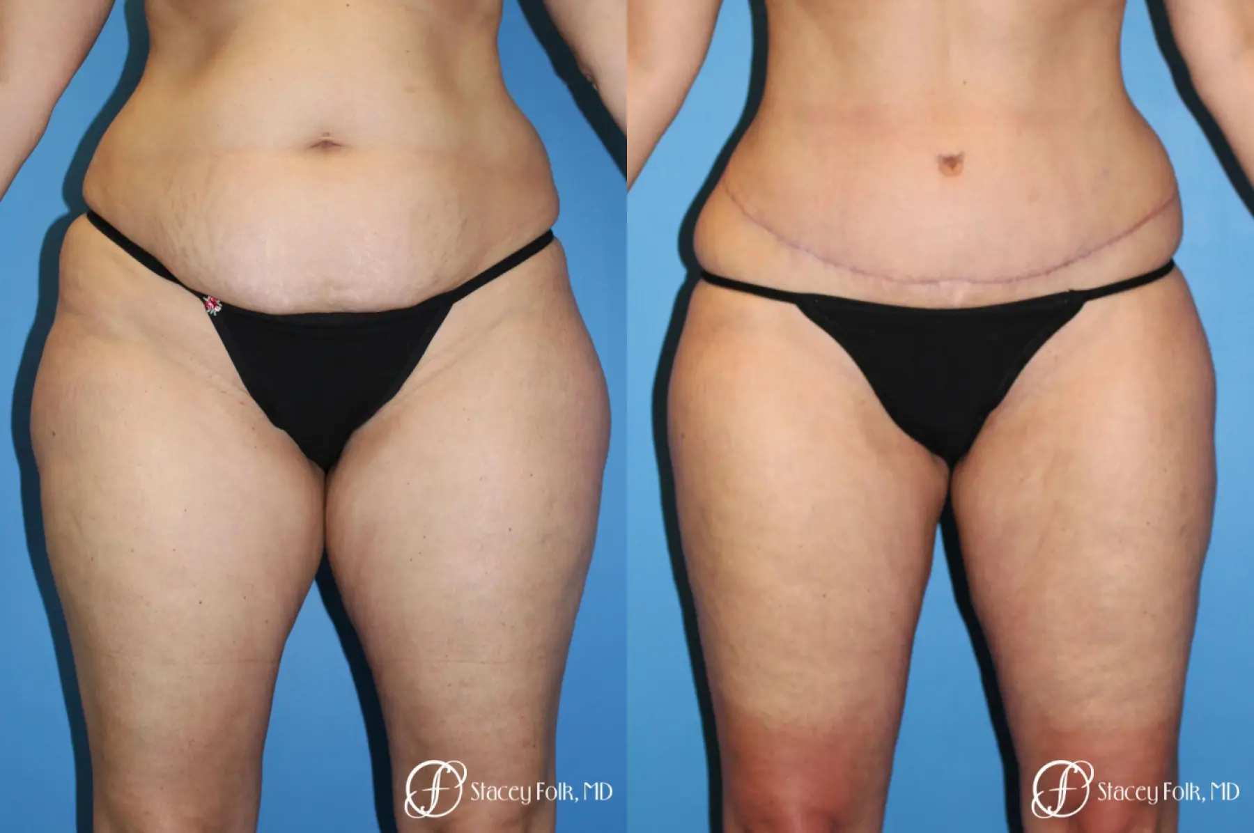 Tummy Tuck - Abdominoplasty - Before and After 1