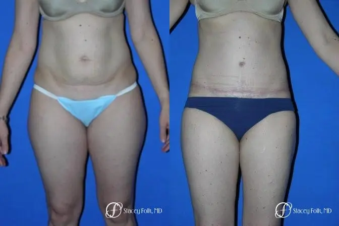Denver Tummy Tuck 35 - Before and After 1