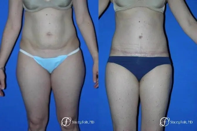 Denver Tummy Tuck 35 - Before and After