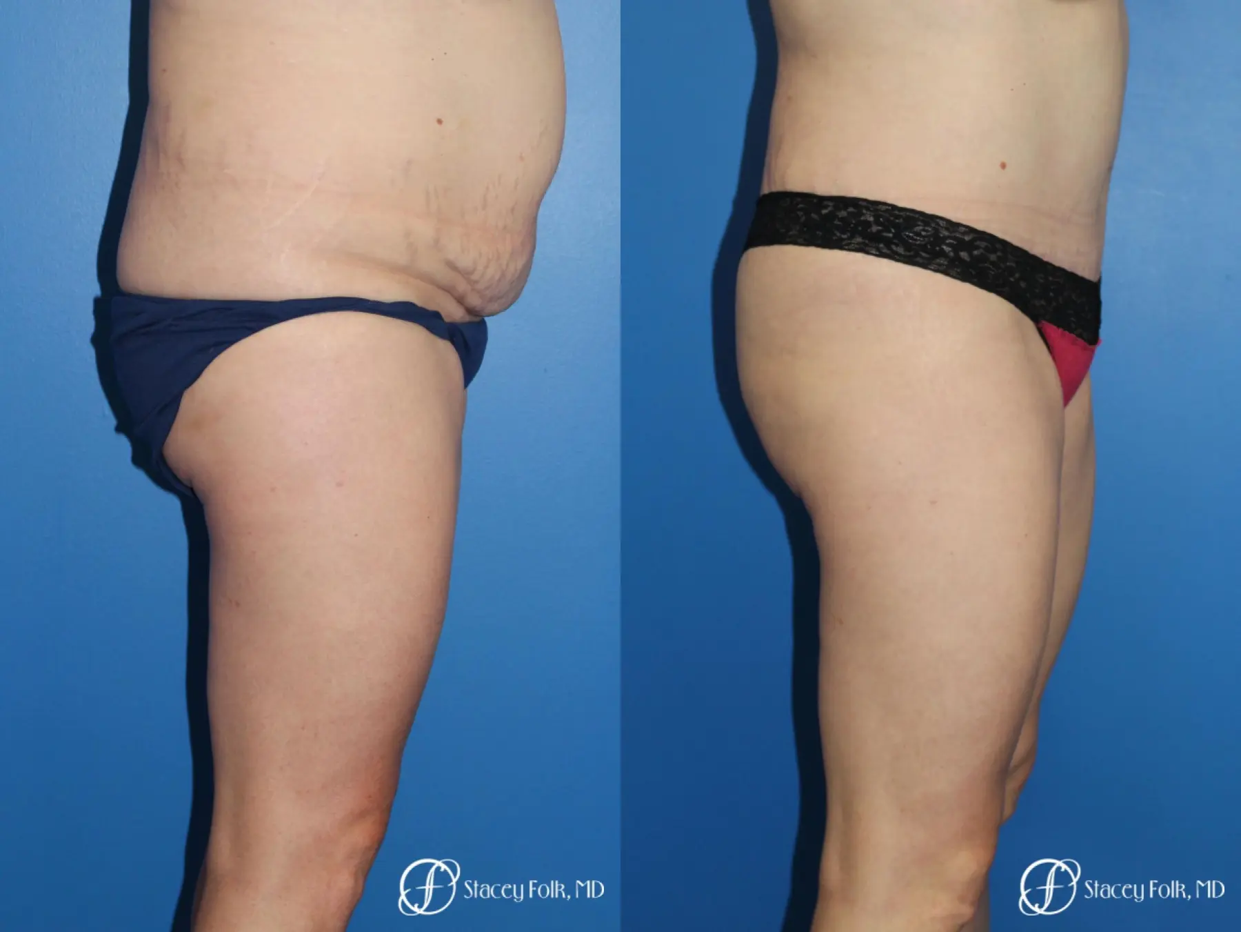 Denver Tummy Tuck (Abdominoplasty) and liposuction 10371 - Before and After 3