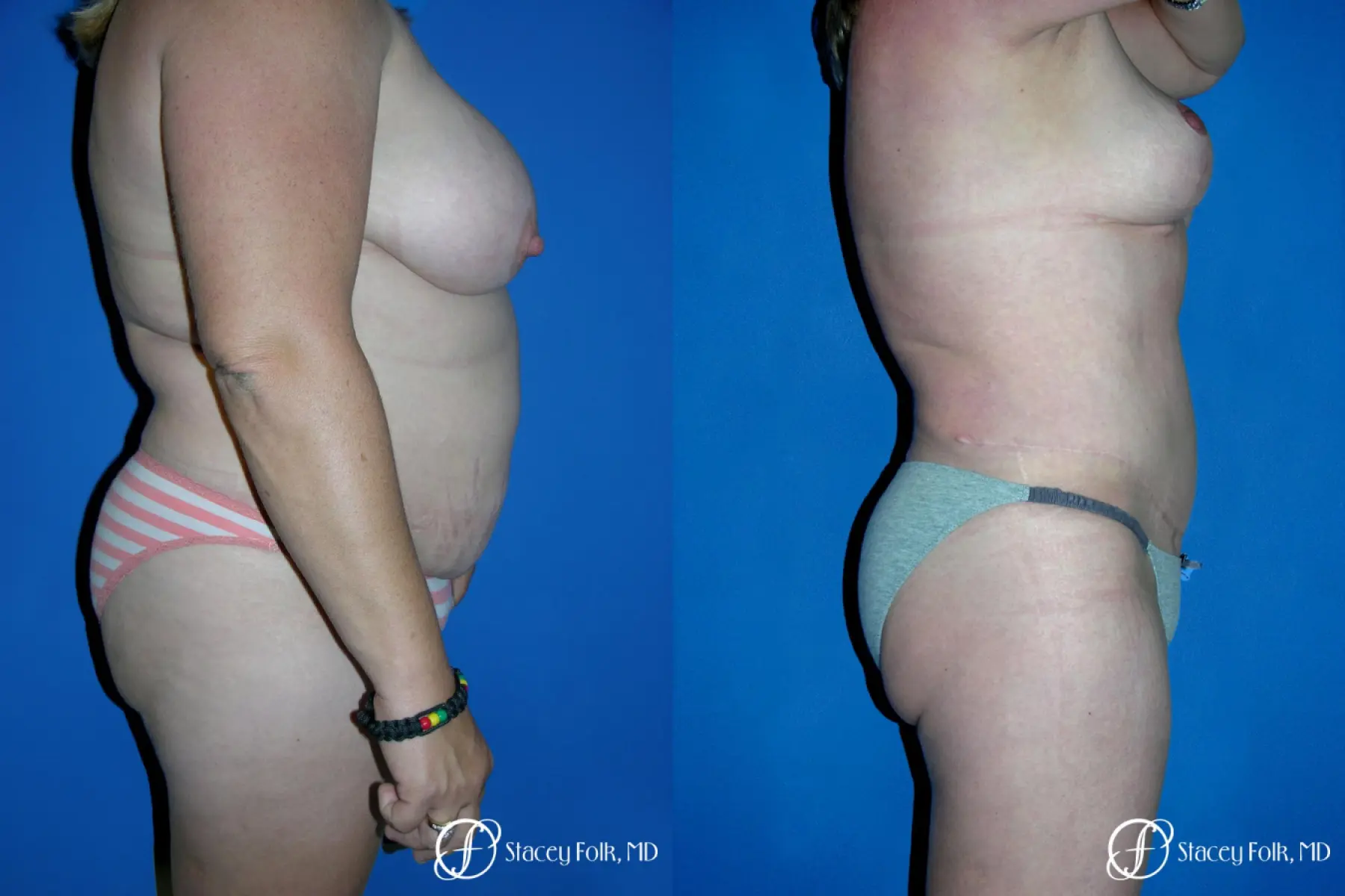 Denver Tummy Tuck 4783 - Before and After 3