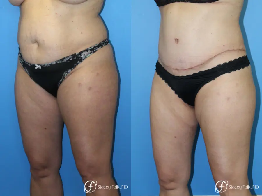 Tummy Tuck (Abdominoplasty) and Liposuction - Before and After 3