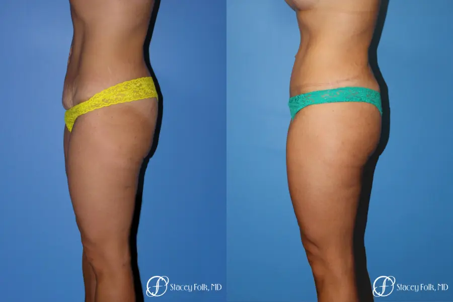 Denver Tummy Tuck Abdominoplasty 5368 - Before and After 3