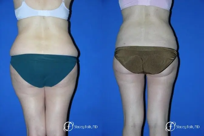 Denver Tummy Tuck 34 - Before and After 3