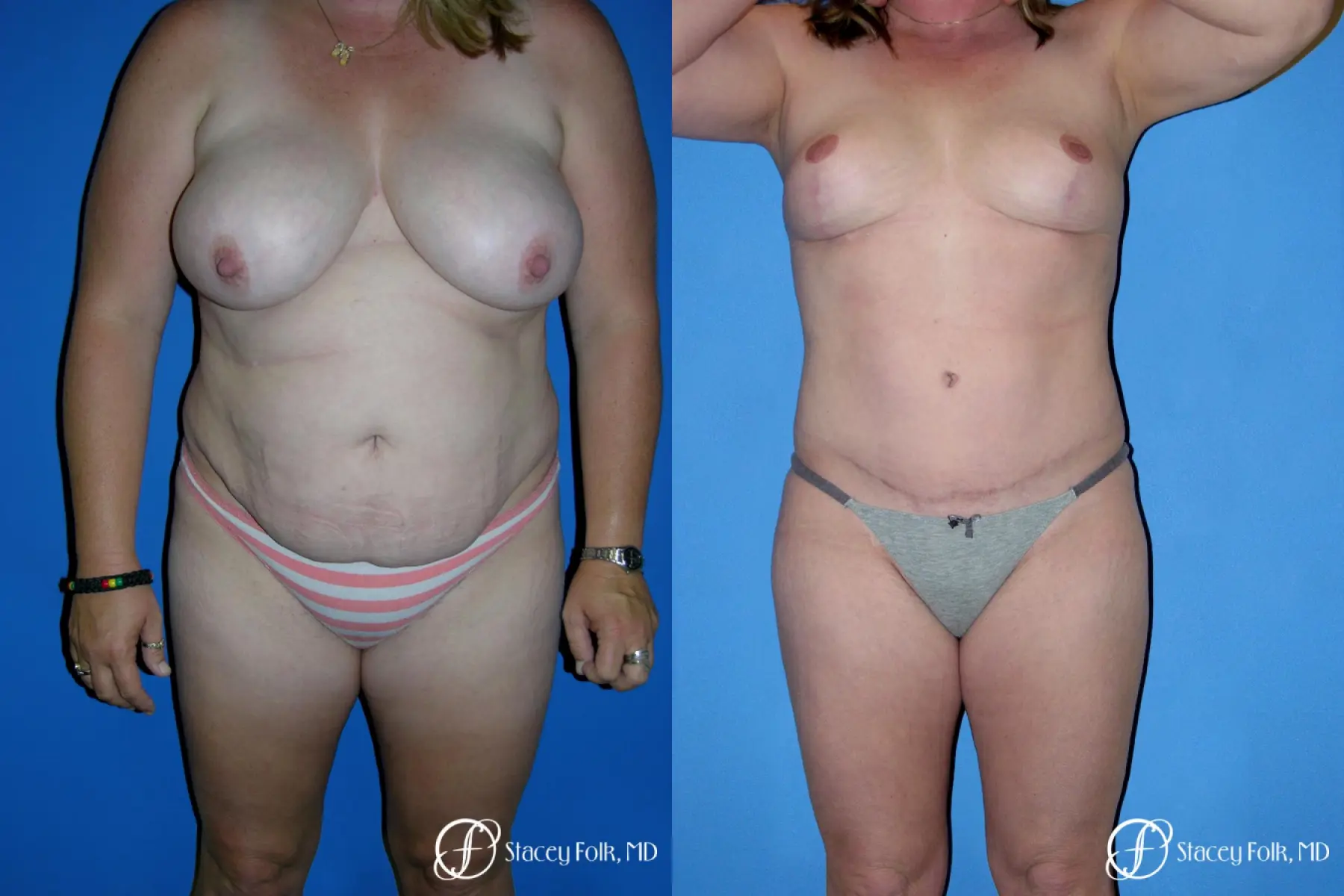 Denver Tummy Tuck 4783 - Before and After 1