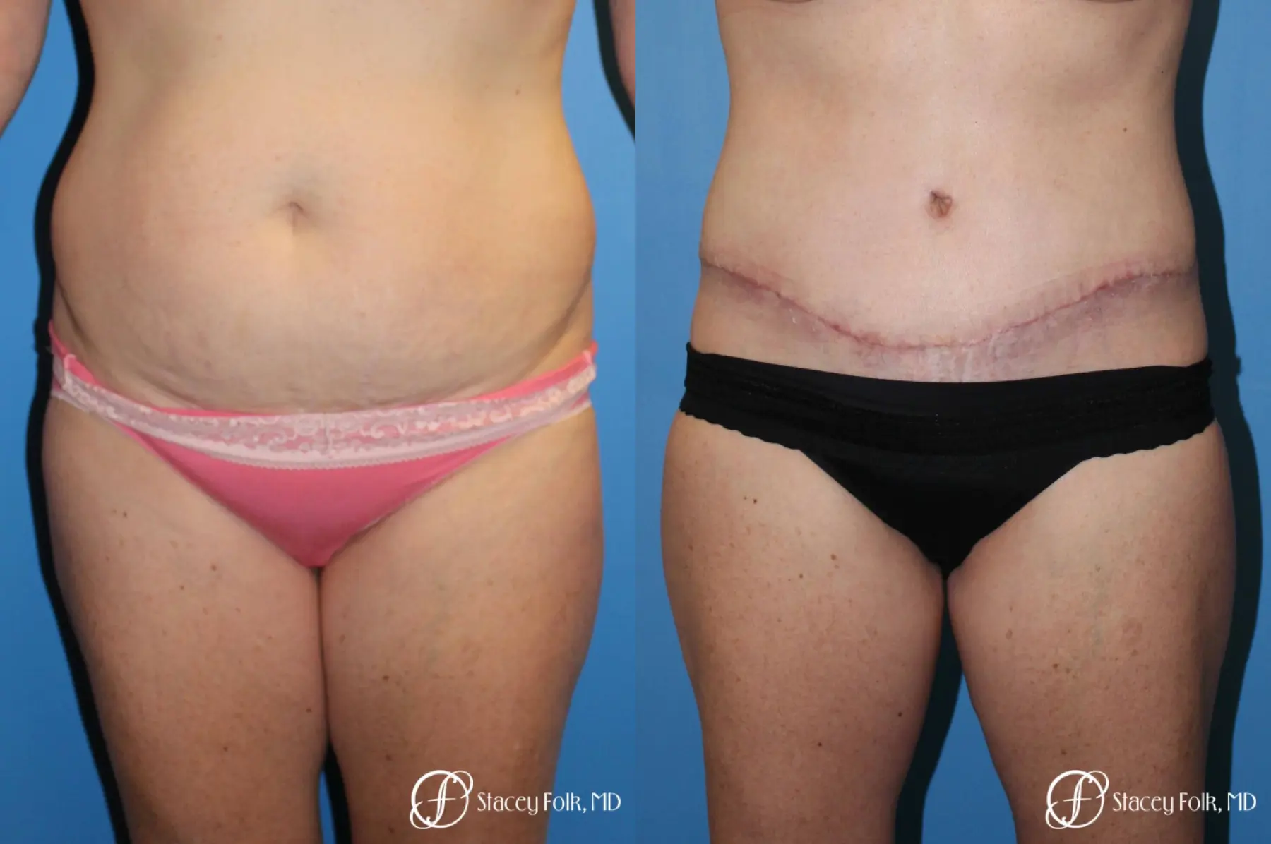 Denver Tummy Tuck 4817 - Before and After 1