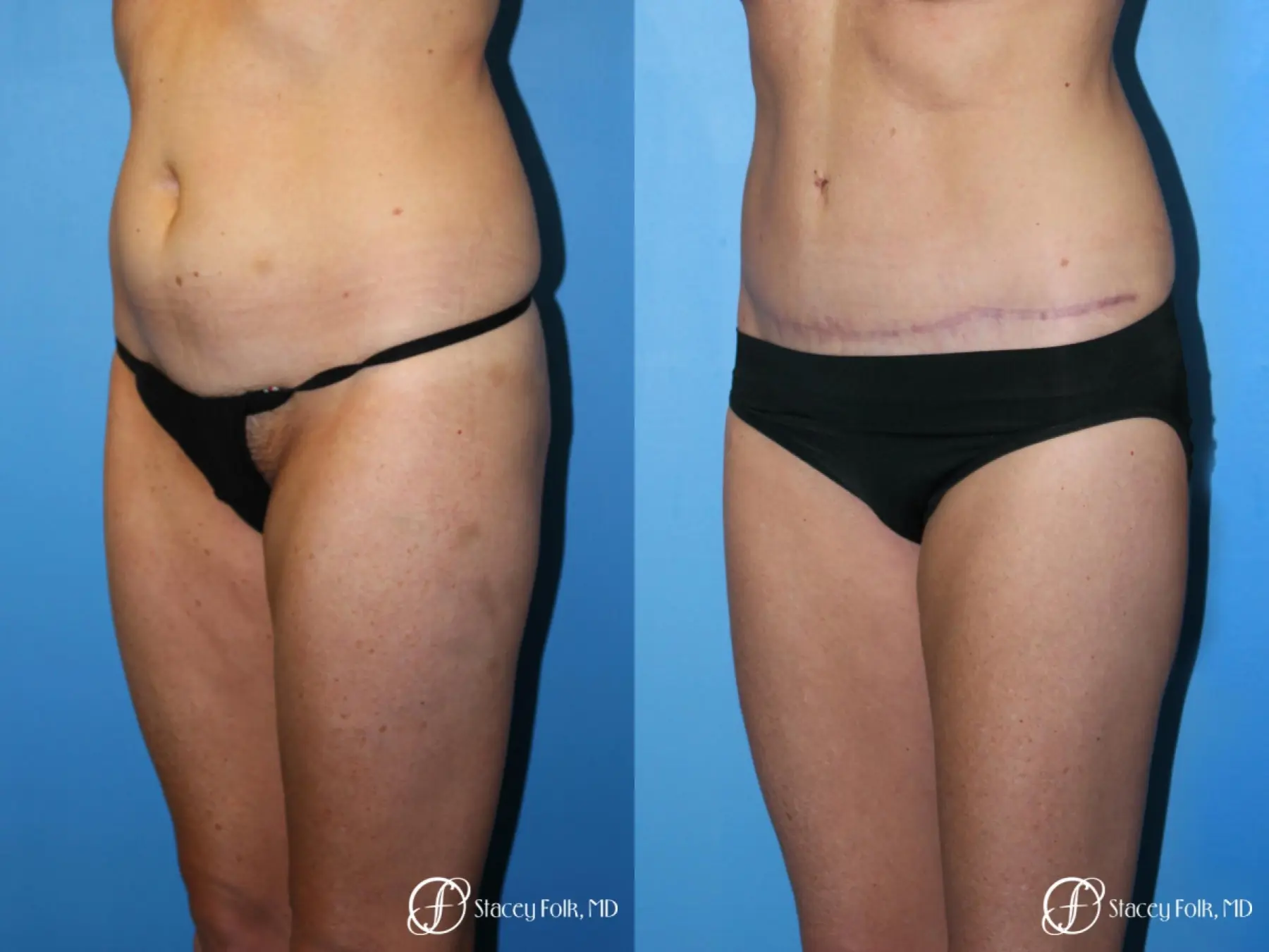 Denver Tummy Tuck - Abdominoplasty 7713 - Before and After 2