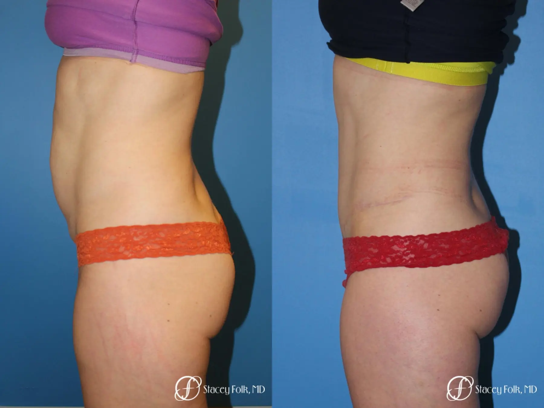 Denver Tummy Tuck - Abdominoplasty 8266 - Before and After 3