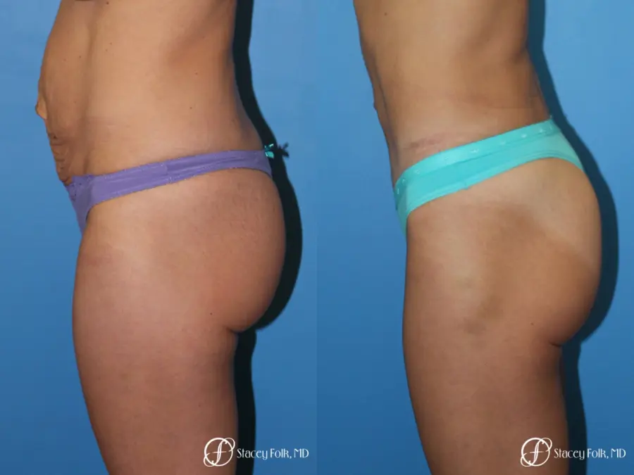 Denver Tummy Tuck - Abdominoplasty 8299 - Before and After 3