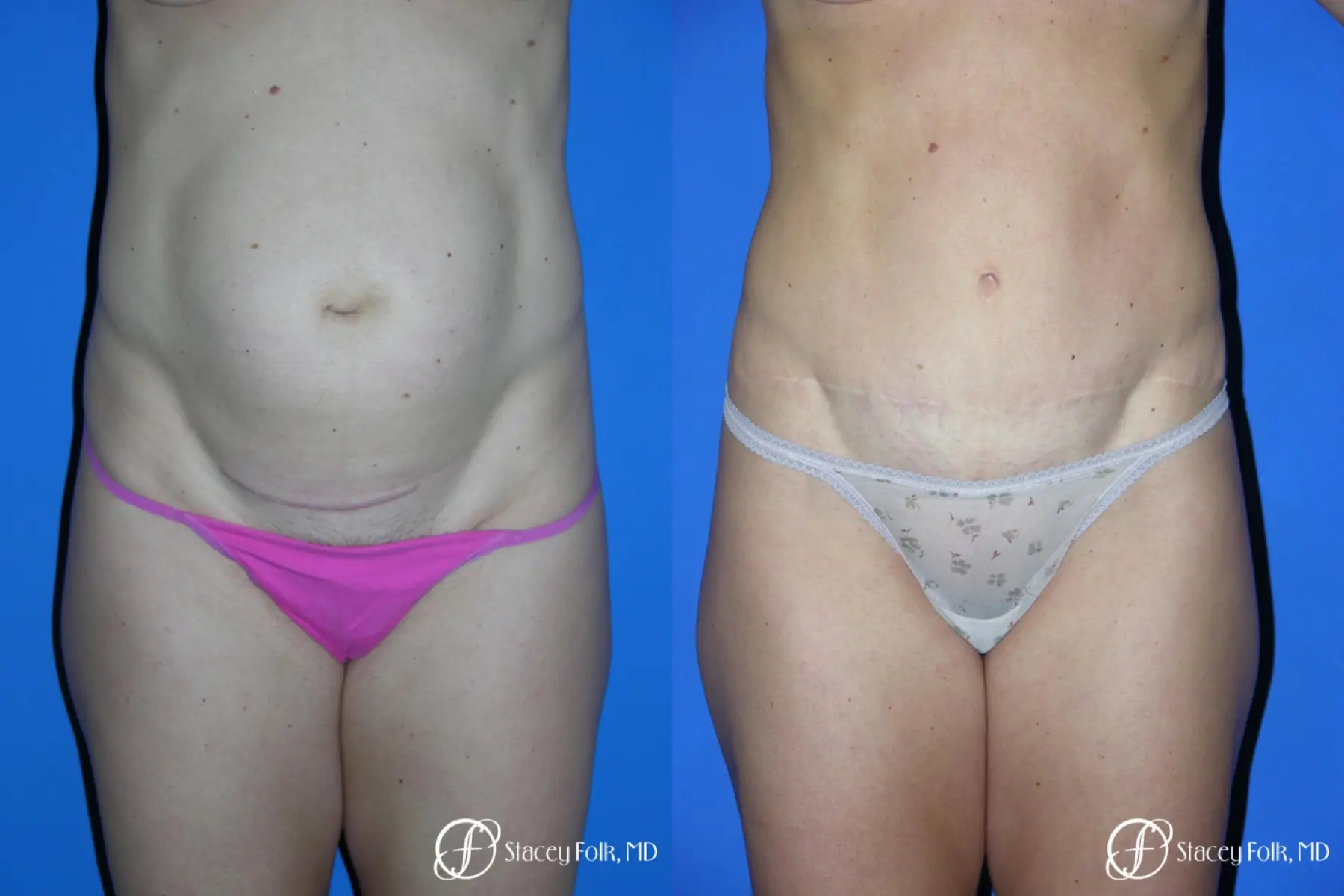 Denver Tummy Tuck 3528 - Before and After