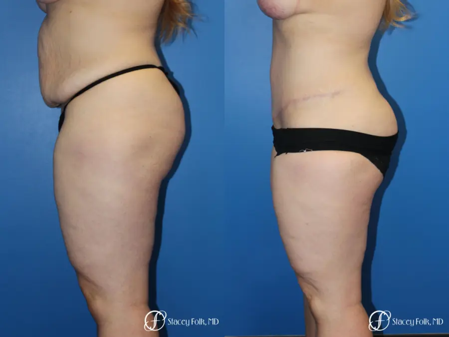 Tummy Tuck (Abdominoplasty) - Before and After 3