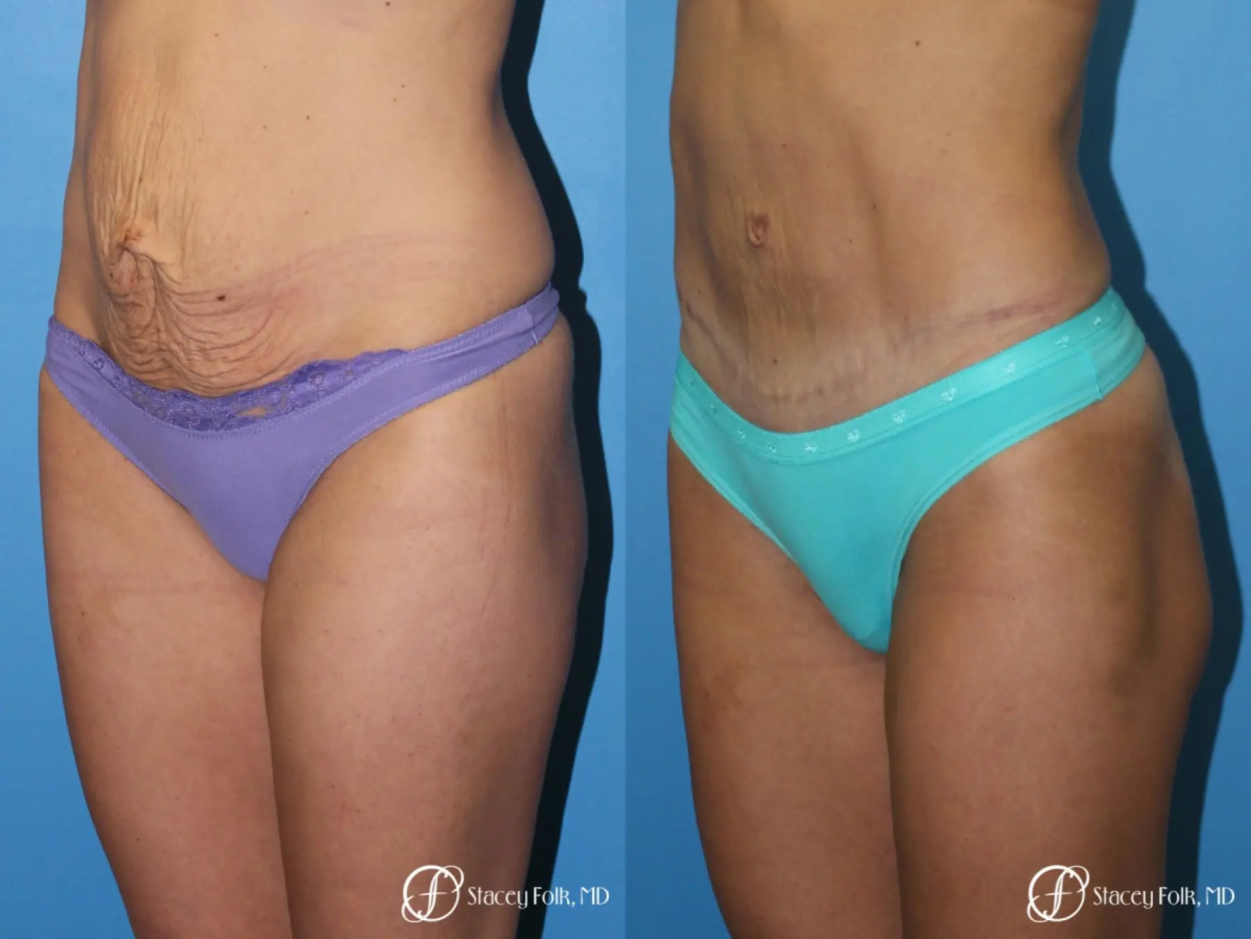 Denver Tummy Tuck - Abdominoplasty 8299 - Before and After 2