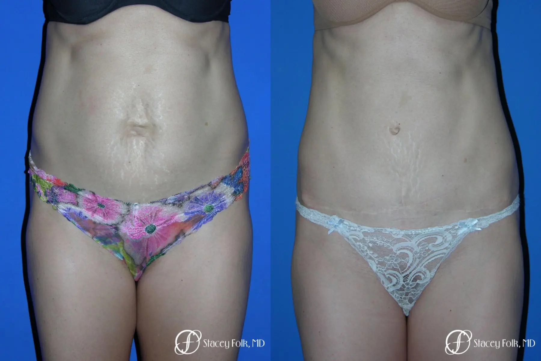 Denver Tummy Tuck Abdominoplasty 5456 - Before and After 1