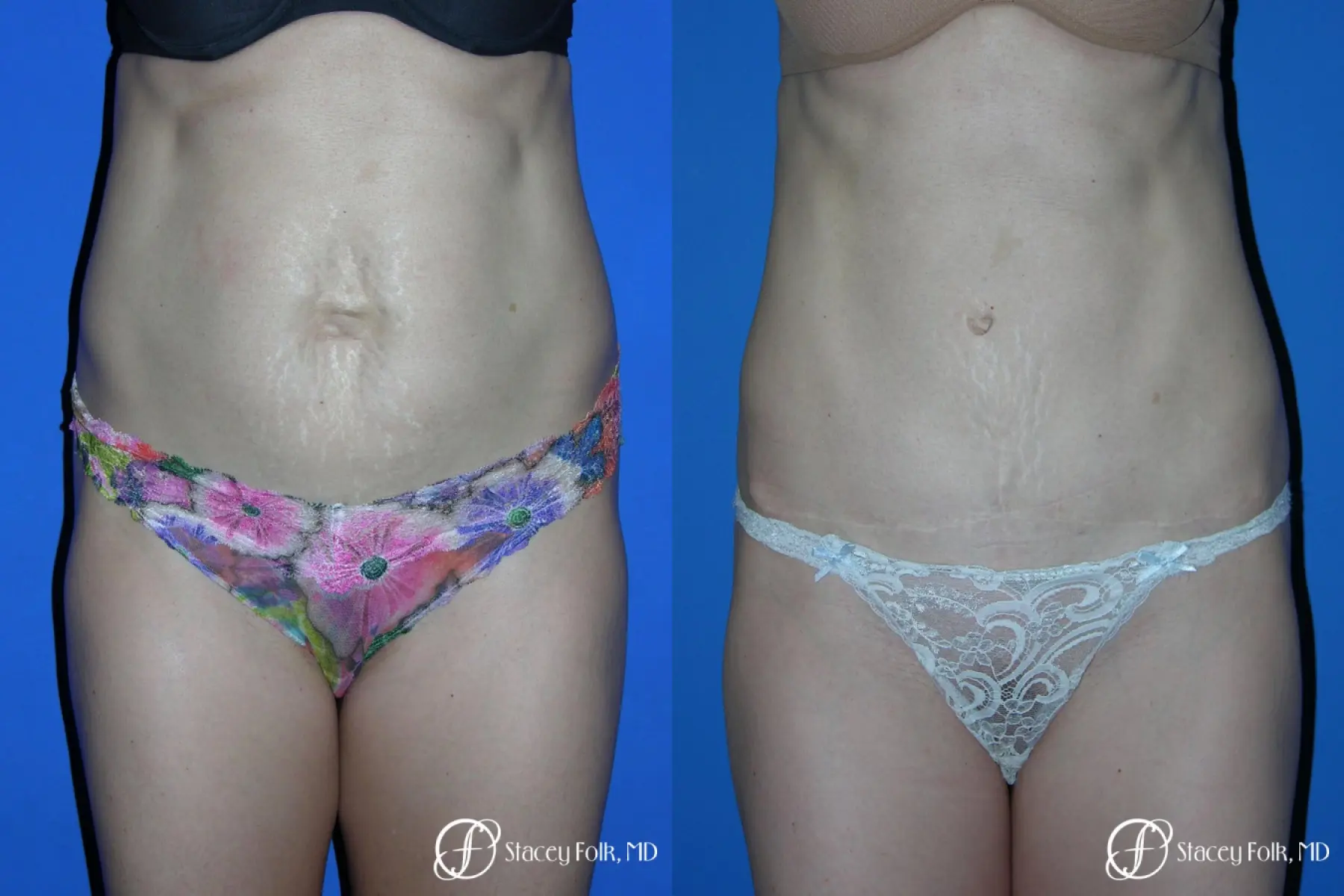 Denver Tummy Tuck Abdominoplasty 5456 - Before and After