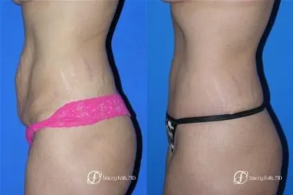 Denver Tummy Tuck 19 - Before and After 2
