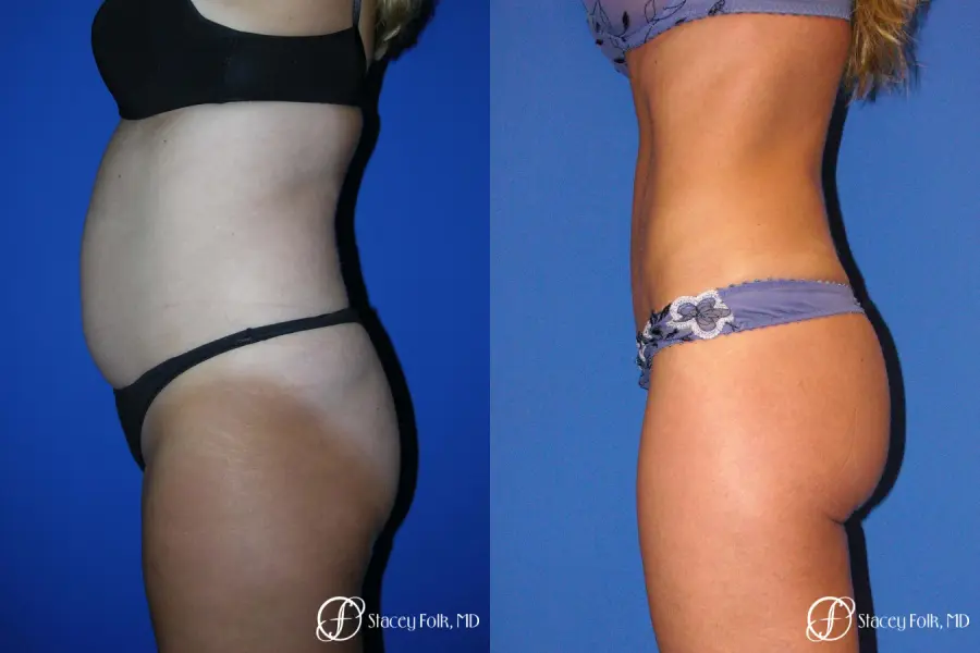 Denver Tummy Tuck - Abdominoplasty 53 - Before and After 2