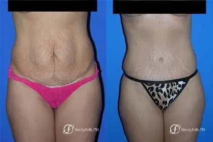 Denver Tummy Tuck 19 - Before and After 1