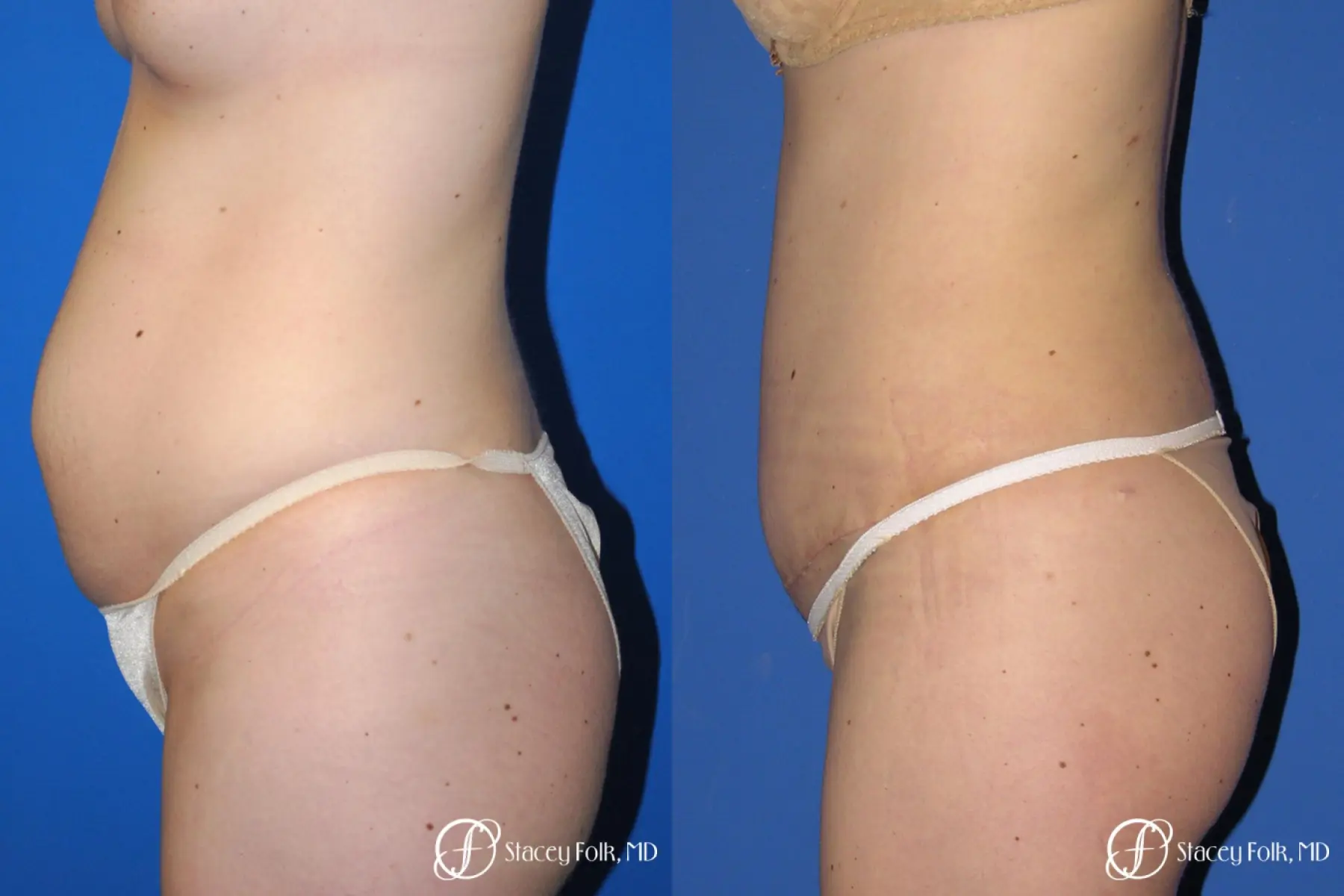 Denver Tummy Tuck - Abdominoplasty 10351 - Before and After 2