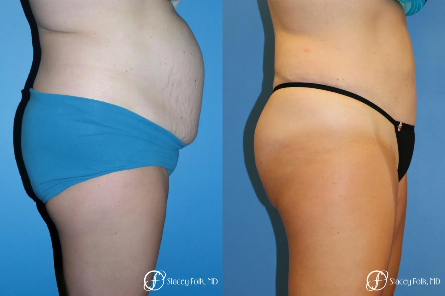 Denver Tummy Tuck - Abdominoplasty 7714 - Before and After 3
