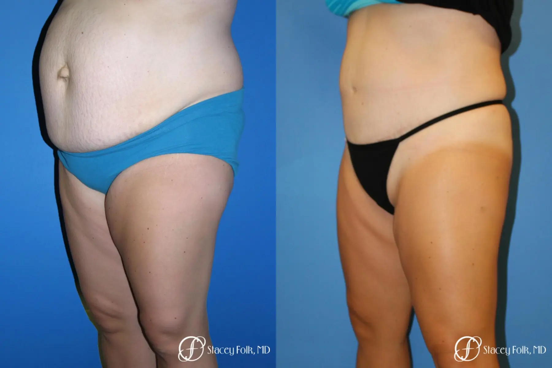 Denver Tummy Tuck - Abdominoplasty 7714 - Before and After 2