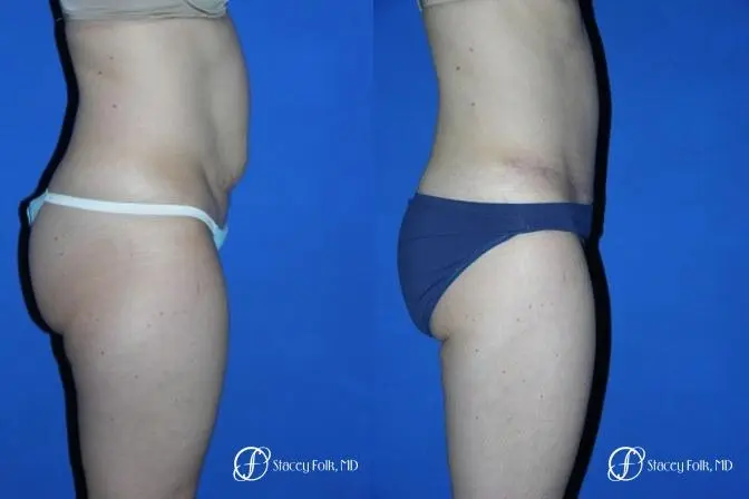 Denver Tummy Tuck 35 - Before and After 3
