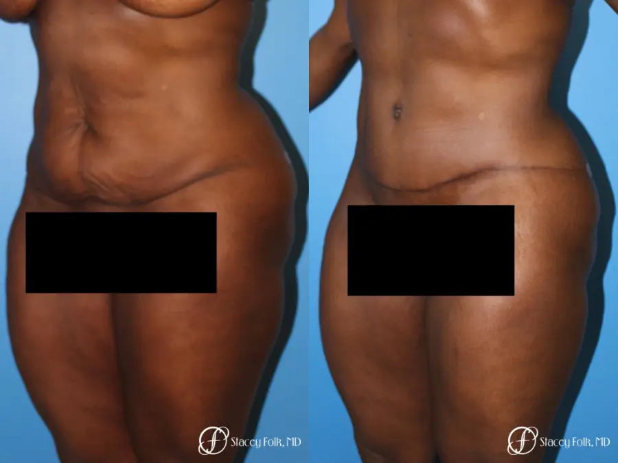 Denver Tummy Tuck - Abdominoplasty 7514 - Before and After 2