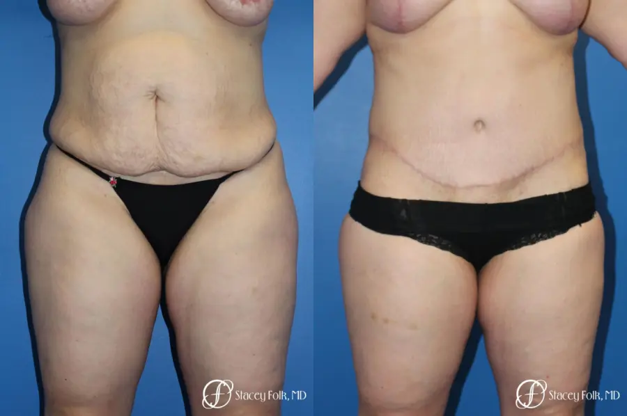 Tummy Tuck (Abdominoplasty) - Before and After