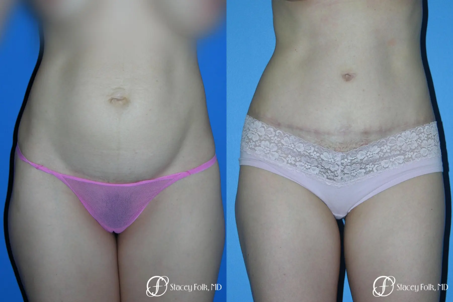 Denver Tummy Tuck - Abdominoplasty 10444 - Before and After 1
