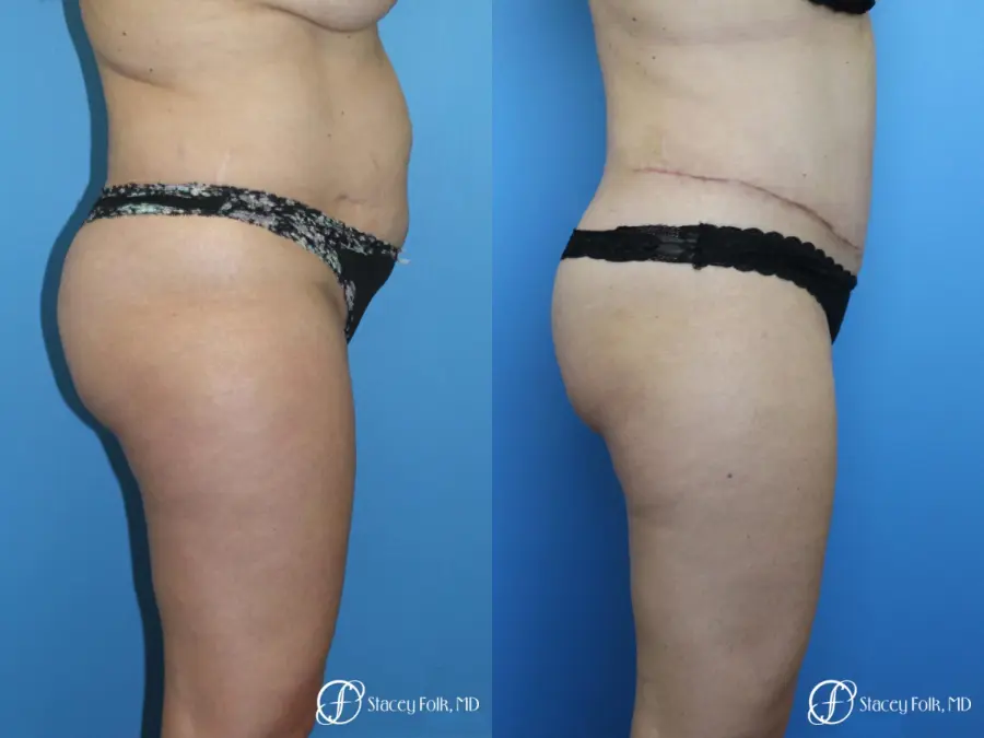 Tummy Tuck (Abdominoplasty) and Liposuction - Before and After 4