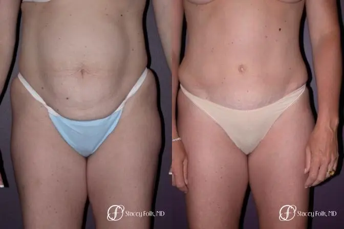 Denver Tummy Tuck 21 - Before and After 1