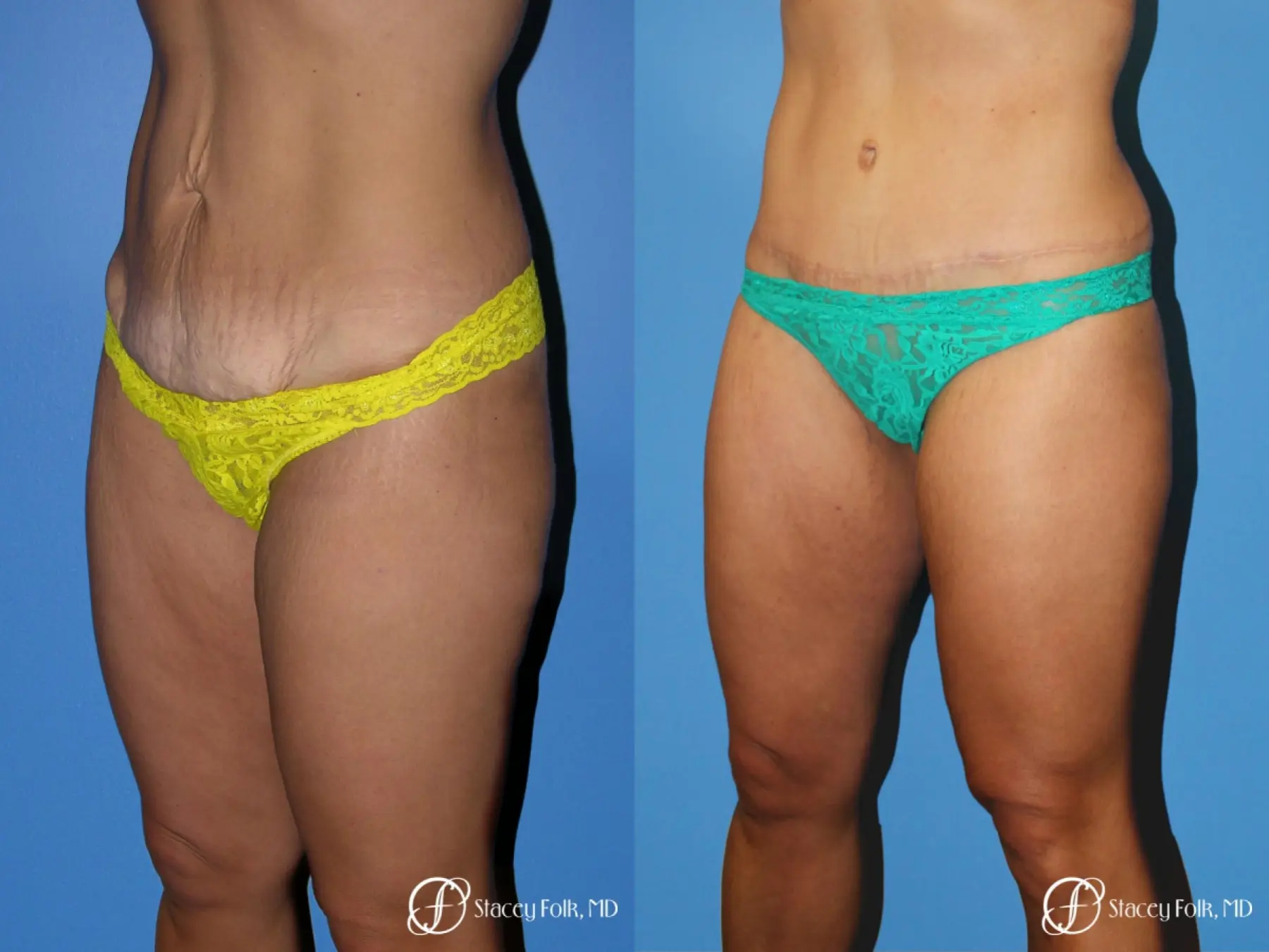 Denver Tummy Tuck Abdominoplasty 5368 - Before and After 2