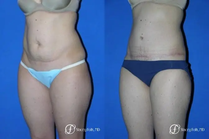Denver Tummy Tuck 35 - Before and After 2