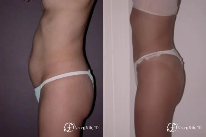 Denver Tummy Tuck 22 - Before and After 2