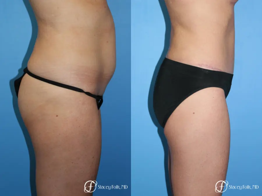 Denver Tummy Tuck - Abdominoplasty 7713 - Before and After 3