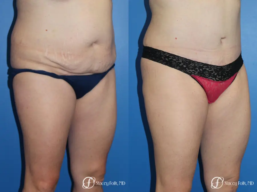 Denver Tummy Tuck (Abdominoplasty) and liposuction 10371 - Before and After 2
