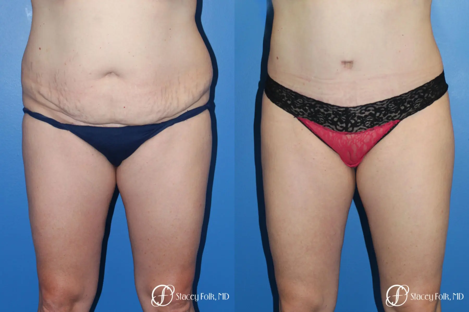 Denver Tummy Tuck (Abdominoplasty) and liposuction 10371 - Before and After 1