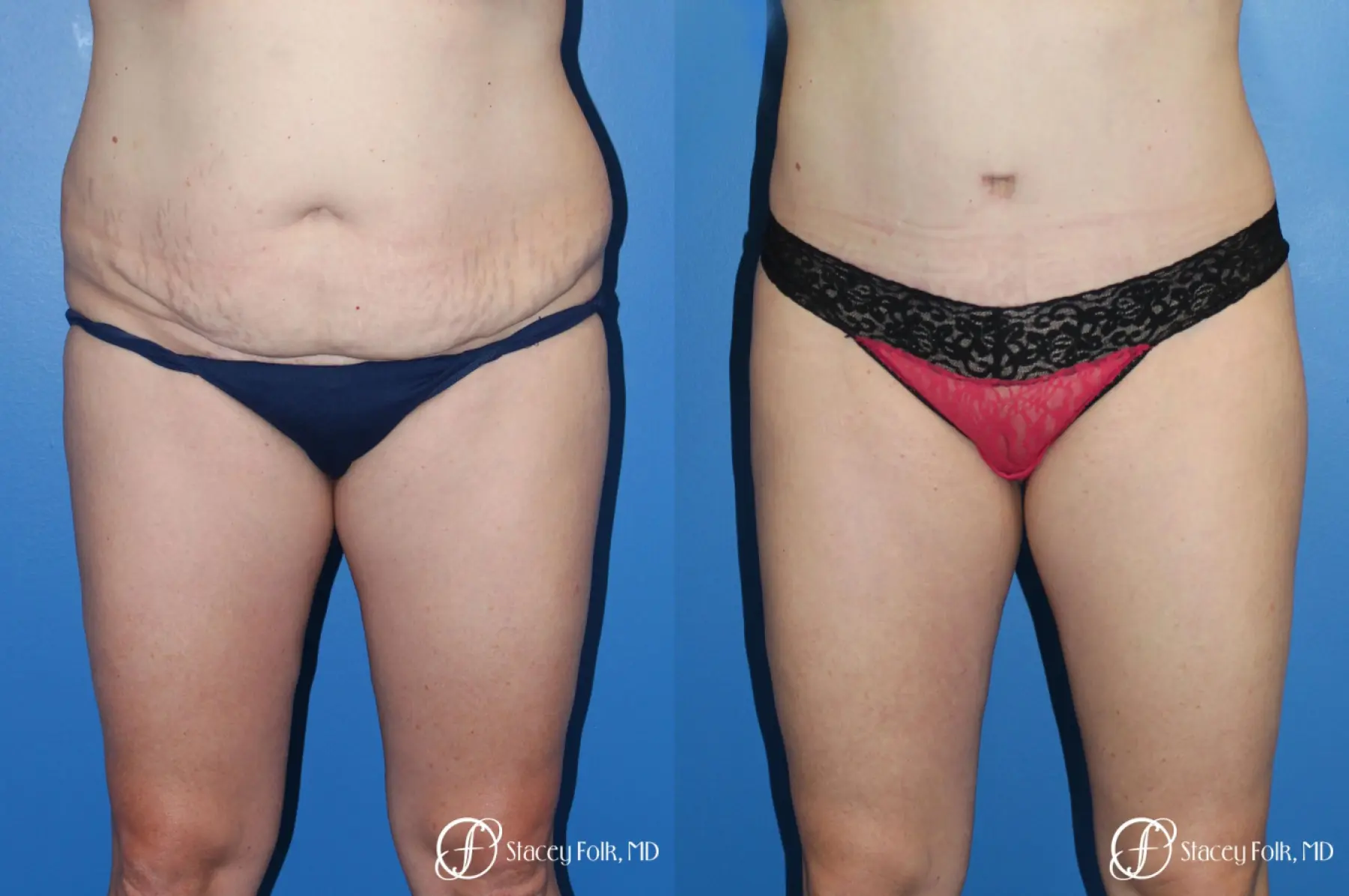 Denver Tummy Tuck (Abdominoplasty) and liposuction 10371 - Before and After