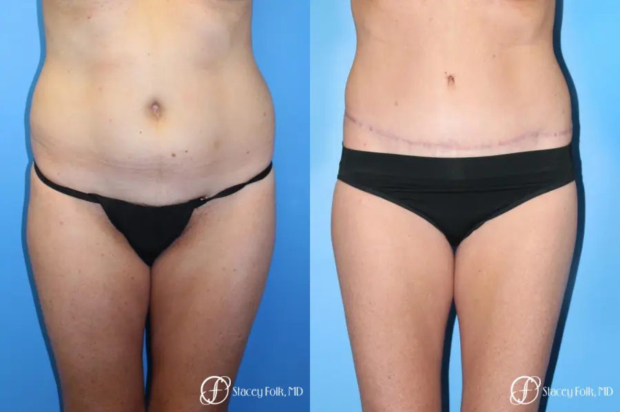 Denver Tummy Tuck - Abdominoplasty 7713 - Before and After 1