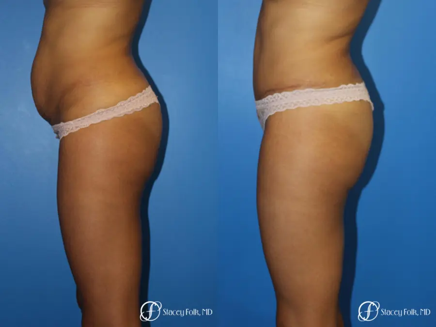 Tummy Tuck (Abdominoplasty) - Before and After 3