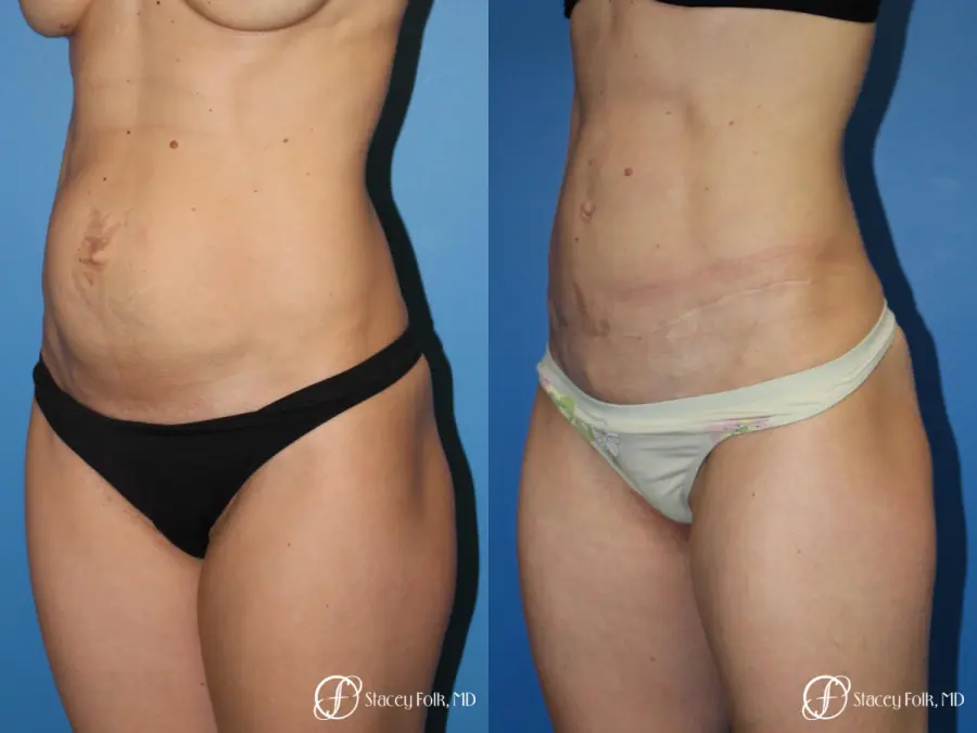 Denver Tummy Tuck (Abdominoplasty) 11239 - Before and After 2