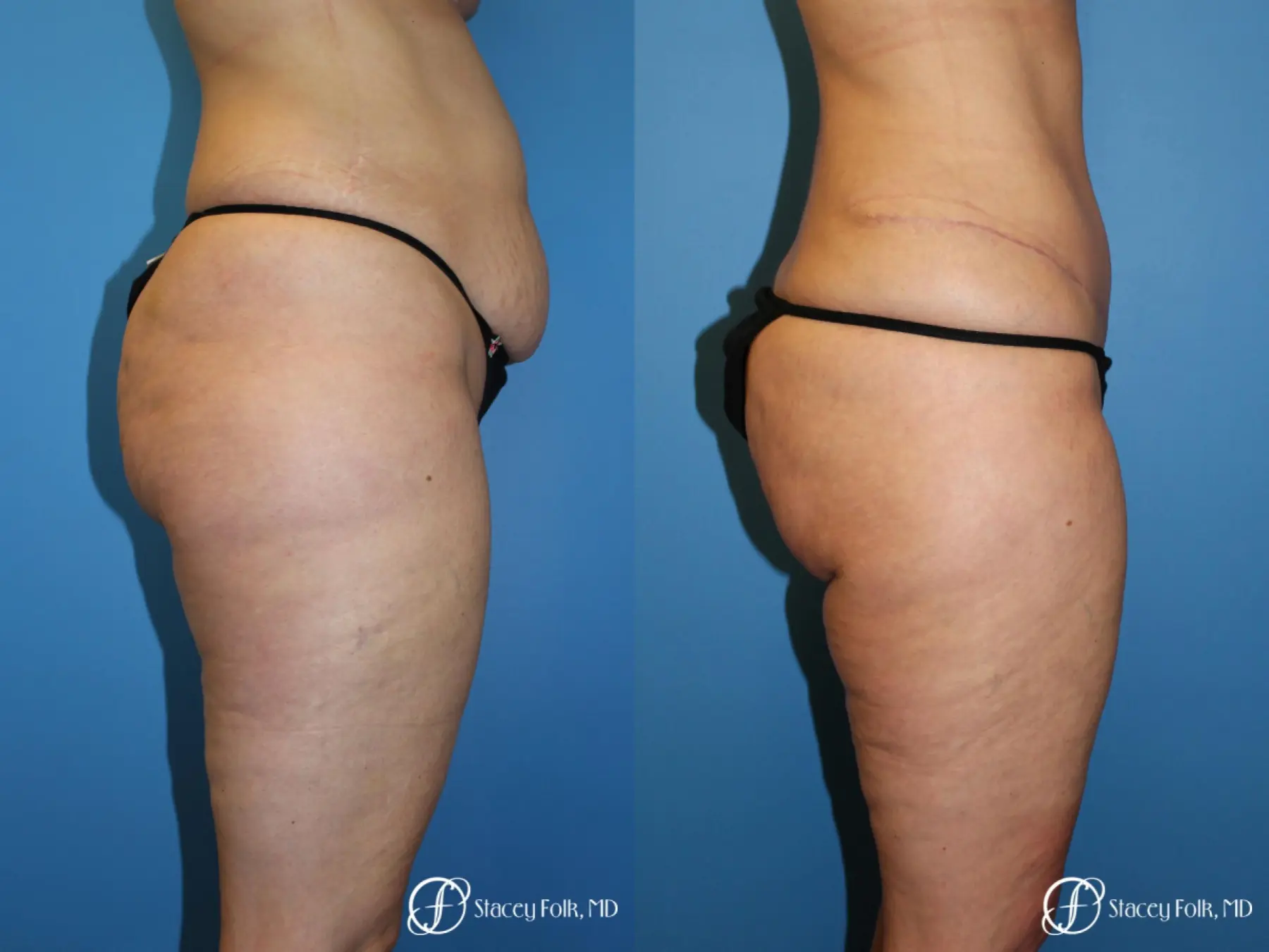 Tummy Tuck - Abdominoplasty - Before and After 3