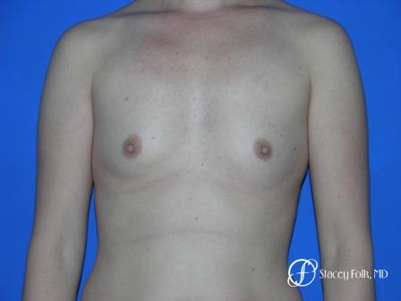 Denver Breast Augmentation 33 - Before Image 1